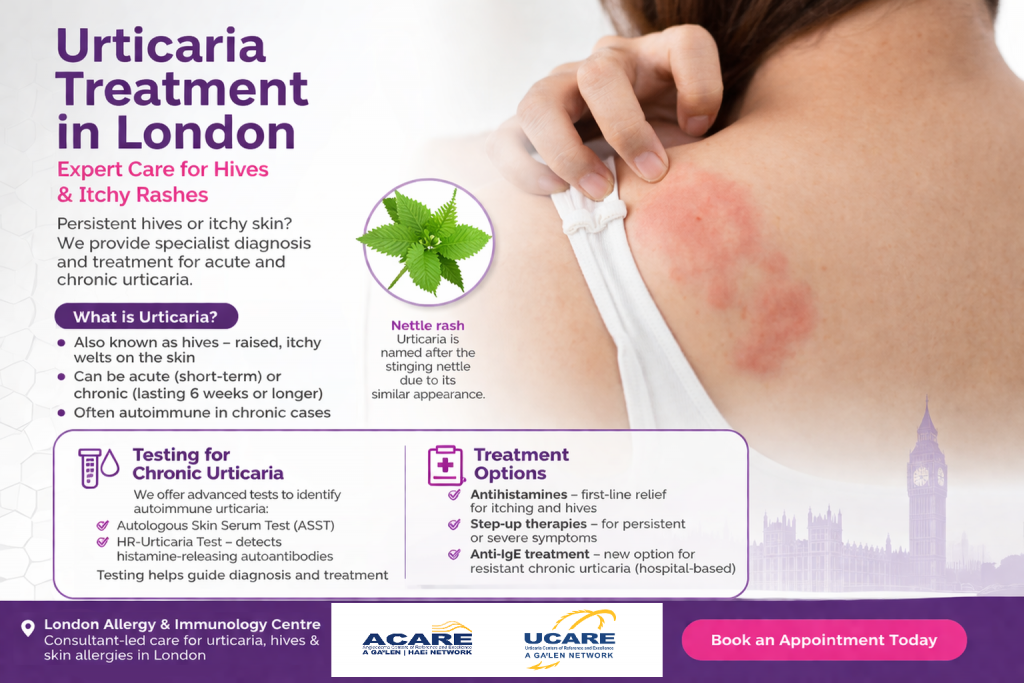 Urticaria hives rash on skin with specialist urticaria treatment in London